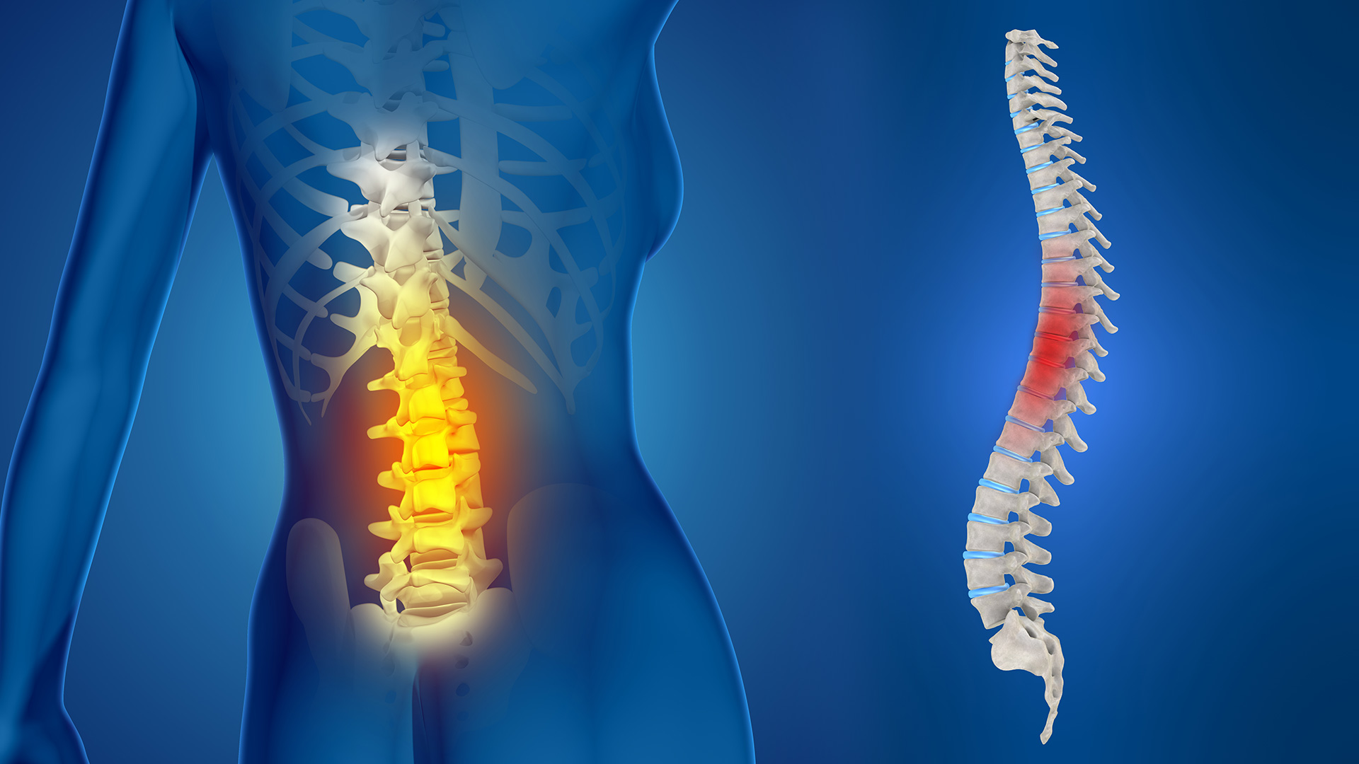 Ciática y Hernia discal – Medicina Integrativa / Holística